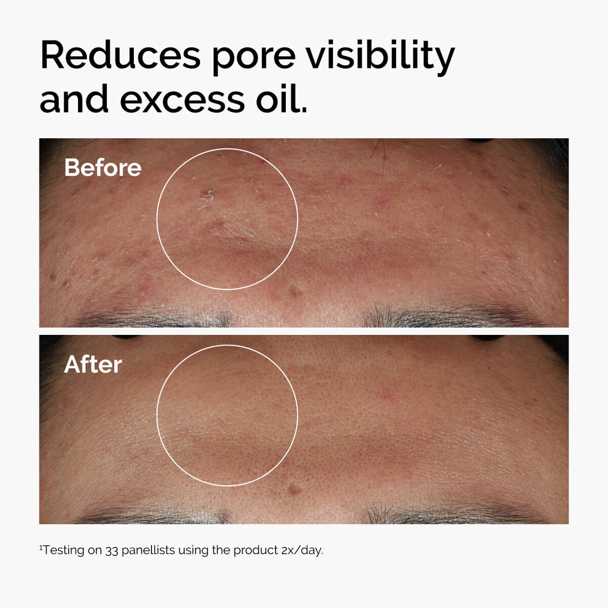 niacinamide-10-zinc-1-b6 ord-niacinamide-zinc-blemish-serum-before-after-pores.jpg