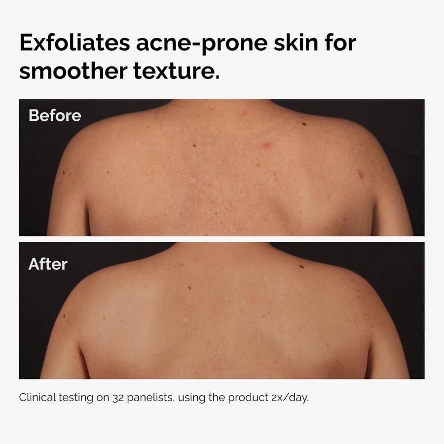 the-body-care-collection-l1 ord-salicylic-acid-body-serum-before-after-graphic-NA.jpg